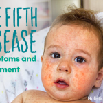 Fifth Disease Symptoms And Treatments