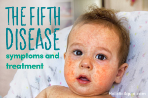 Fifth Disease Symptoms and Treatments - Holistic Squid