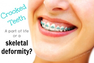 Crooked Teeth - A part of life or skeletal deformity? - Holistic Squid