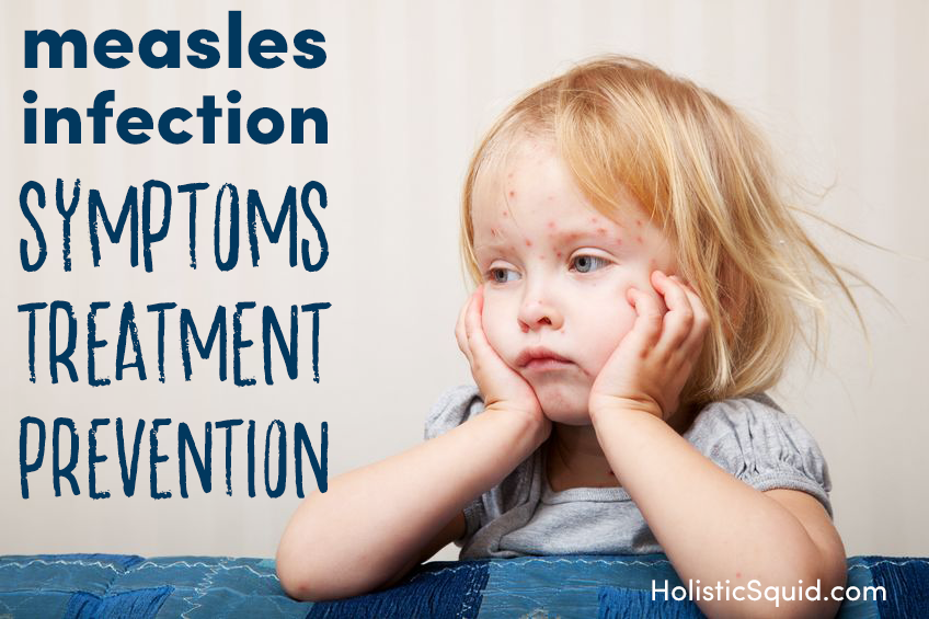 Measles Infection: Symptoms, Treatment and Prevention - Holistic Squid