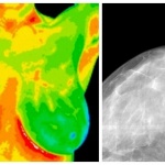 Breast Thermography vs. Mammogram – Earlier Screenings May Save Your Life