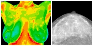 Breast Thermography Vs. Mammogram - Holistic Squid