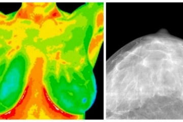 Breast Thermography vs. Mammogram – Earlier Screenings May Save Your Life