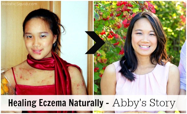 Healing Eczema Naturally - Abby's Story - Holistic Squid