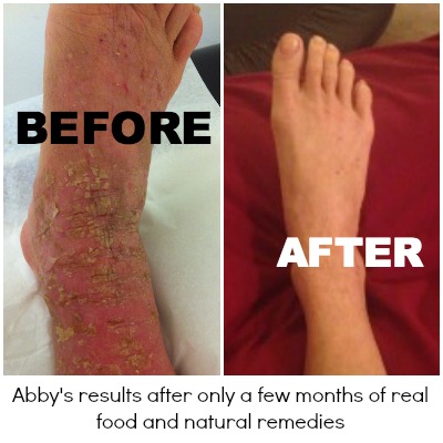 Abby's Eczema Before and After - Healing Eczema Naturally